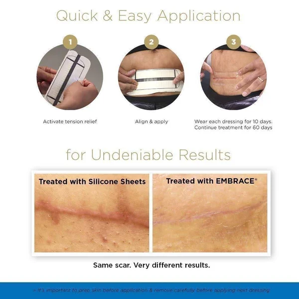 Embrace Scar Treatment, Silicone Sheets for New Scars with Active Scar Defense